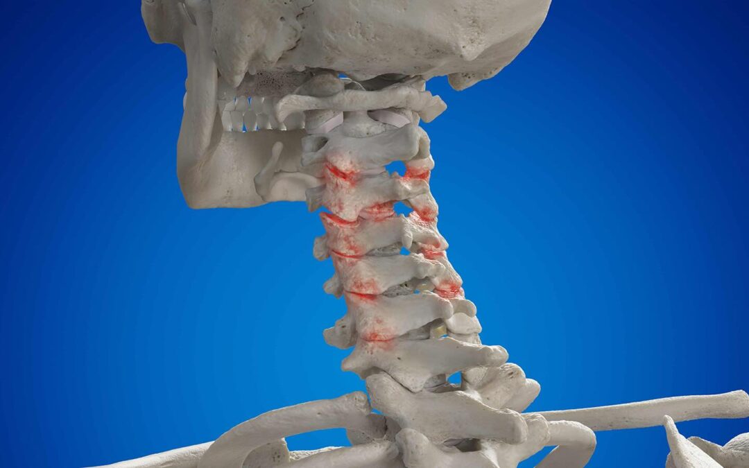 artrosis cervical artrosis cervical
