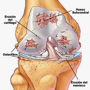degeneración articular