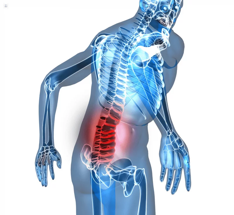 lumbartrosis